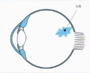 高度近视为什么易出现眼底出血