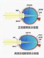 生活中如何避免高度近视并发症
