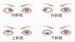 斜视的病因
