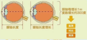 监测眼轴为什么能防控近视?