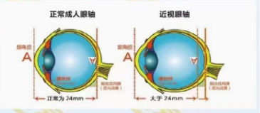 为什么没有儿童眼轴的基本标准?