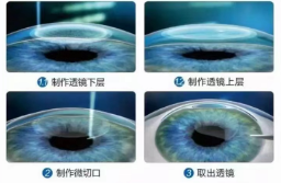 做近视手术之后，还会再近视吗?