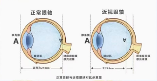 青少年眼轴为什么容易增长?