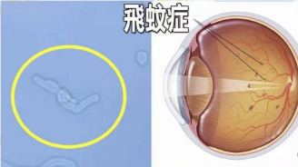 飞蚊症和视网膜脱离的关系