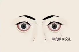 眼睛突然“变大”一定要小心