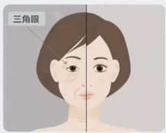 什么是年龄相关性眼脸松弛?