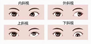 远视会引起调节和集合联动异常