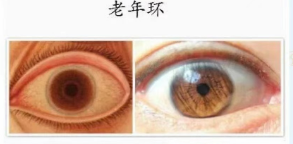 为什么老年人眼睛会有老年环?
