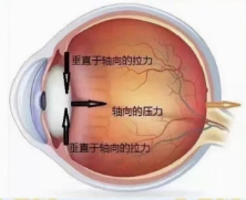 眼轴异常增长的原因之一