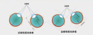 屈光参差的病因有哪些?