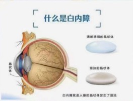 这些户外工作者容易得白内障