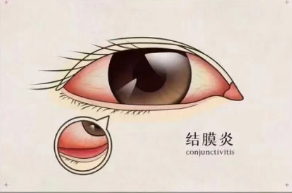 结膜炎会自愈吗?