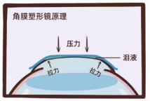 哪些人不适合佩戴角膜塑形镜?
