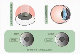 角膜屈光手术类型